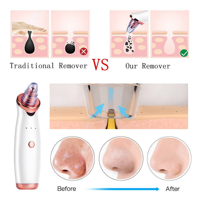 Electric Suction Blackhead Remover